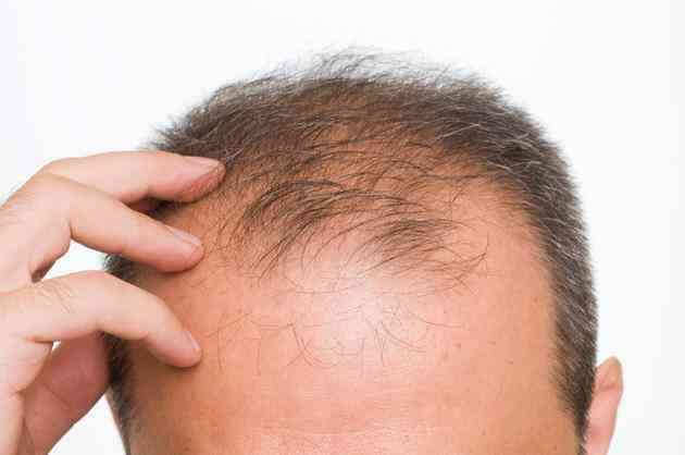 male-pattern-baldness-main_0